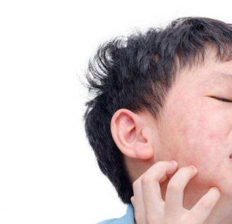 急性荨麻疹对人体哪些危害